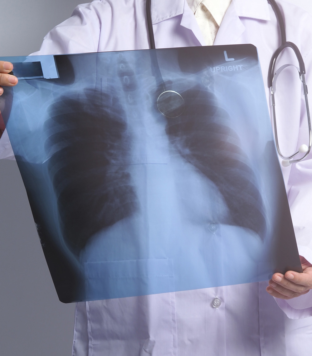 deteccion precoz cancer de pulmon