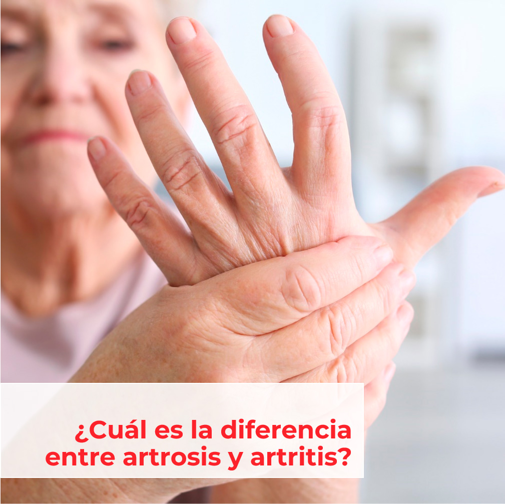 Artrosis. Síntomas, diagnóstico y tratamiento. Clínica U. Navarra